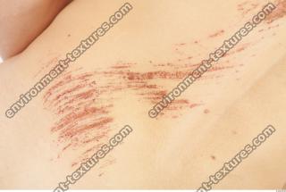 human skin scar 0005